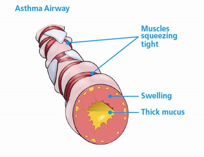 What is asthma?